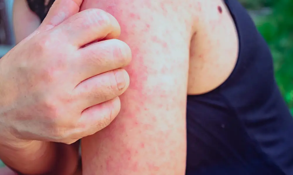 Quais-sao-os-riscos-da-gestante-pegar-sarampo-1000x600